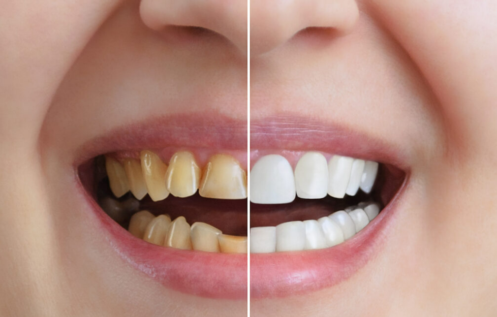 2026TikTok 美区爆款出圈：DRDENT 牙齿美白贴片成跨境美妆新宠